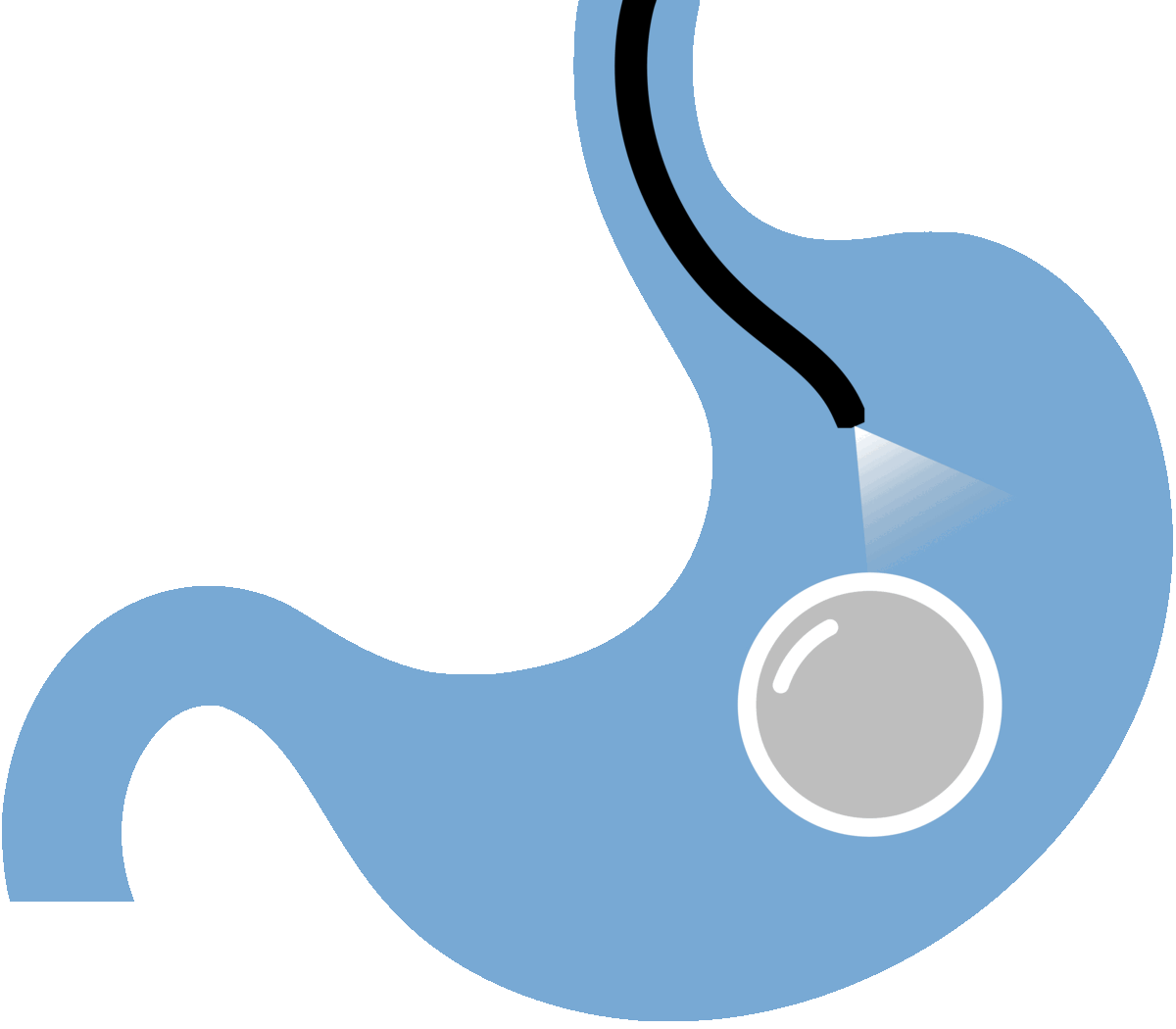 Allurion Balloon