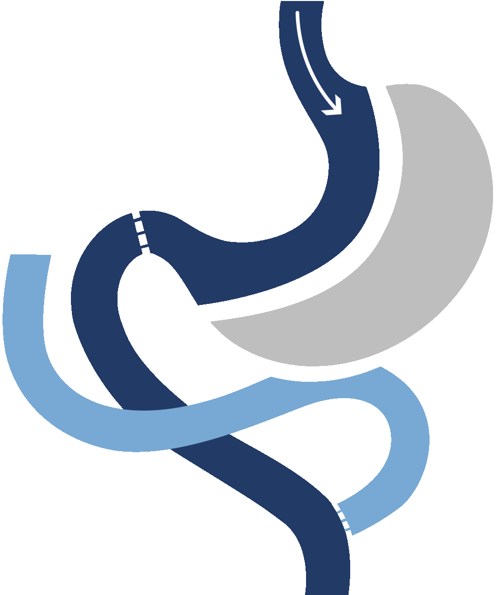 DUODENAL SWITCH