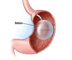 Endoscopic Gastric Balloon