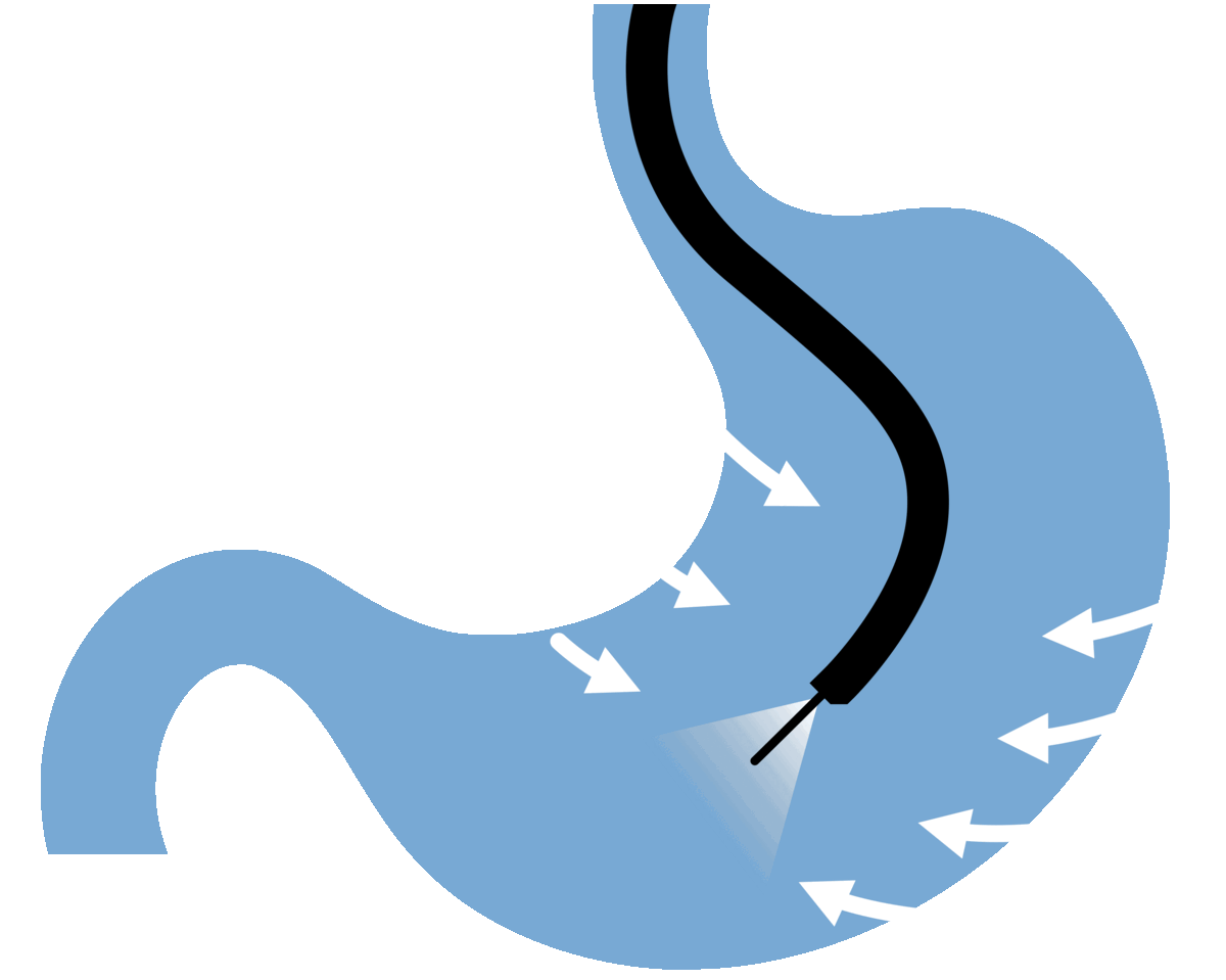 DUODENAL SWITCH