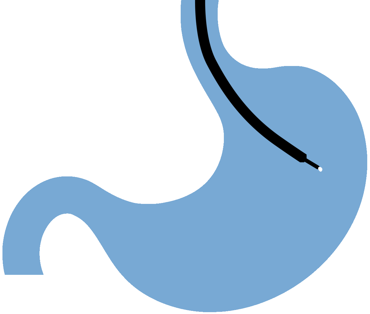 DUODENAL SWITCH