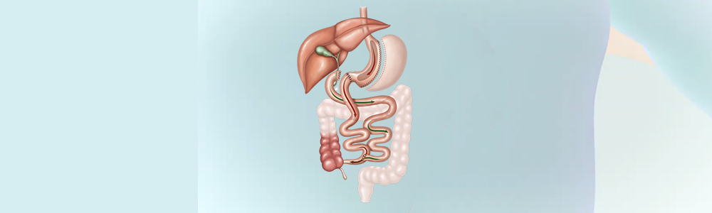 Duodenal Switch
